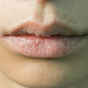 4 common mistakes that make one&#8217;s lips dry and damaged